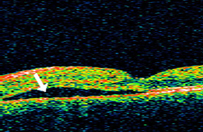 Central serous choroidoretinopathy treated at Craig M. Fern, M.D., P.C.