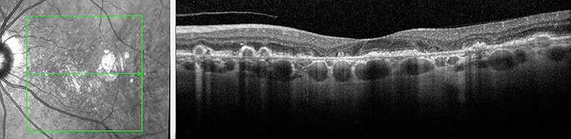 OCT scan of human retina cross-section.