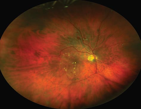 Retinal image showing blood vessels and macula.