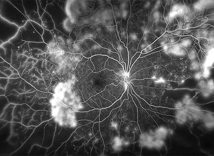 Black and white retinal blood vessel image.